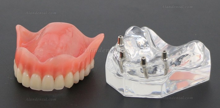 Dental Study Teeth Model Overdenture Superior With 4 Implants Demo Model 6001